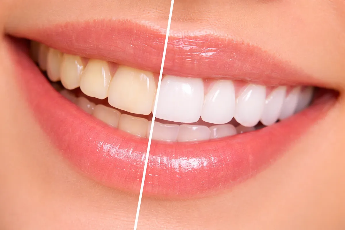 Clareamento Dental